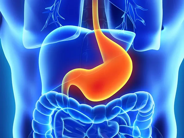 What is Reflux Surgery