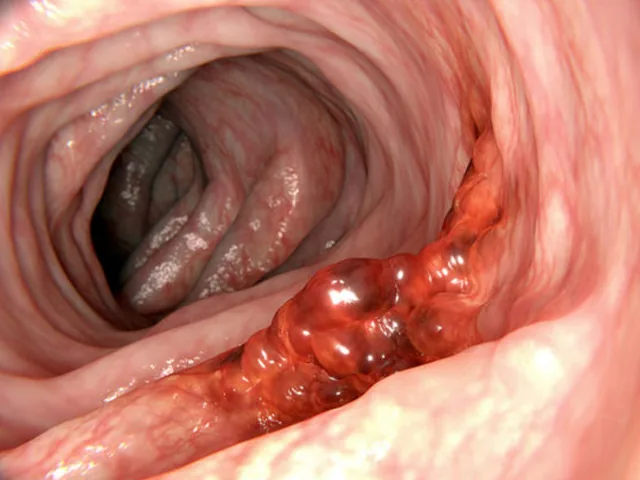 Ce este cancerul colorectal