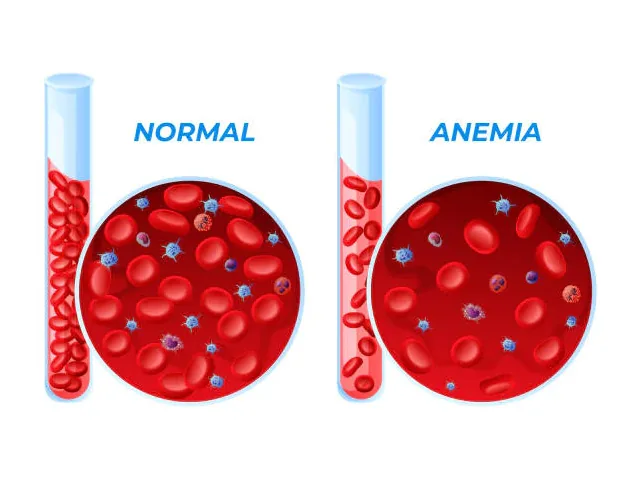 Ce este Anemia?