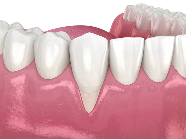 Ce este recesiunea gingiilor?